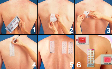 alergia-kozne-testy-truetest.jpg